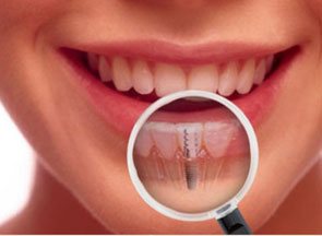 dental implants bundoora